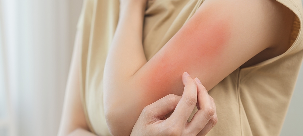 Yaz aylarında cilt döküntüleri neden olur? Cilt döküntüleri nasıl geçer?