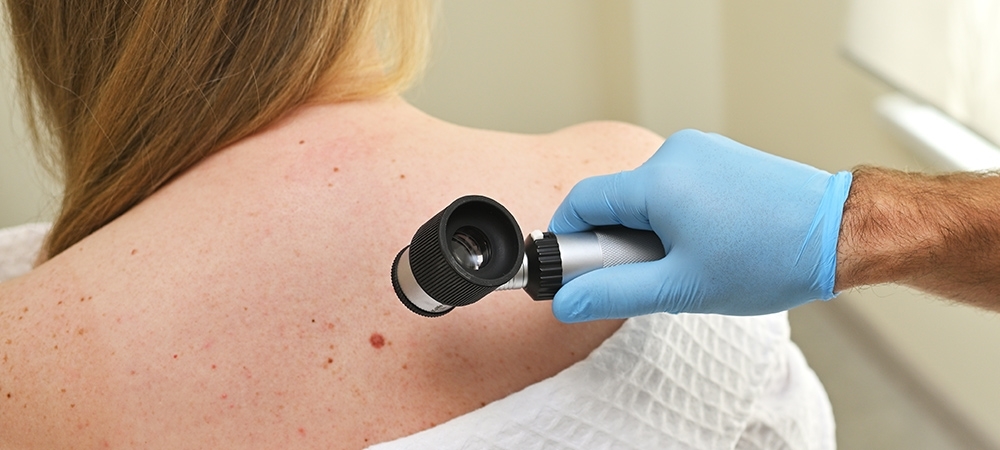 Cilt kanseri neden olur? Cilt kanserinin tedavisi nasıl olur?