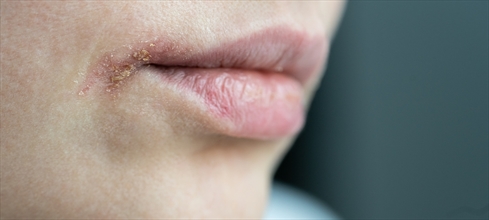 Ağız yarasına ne iyi gelir?