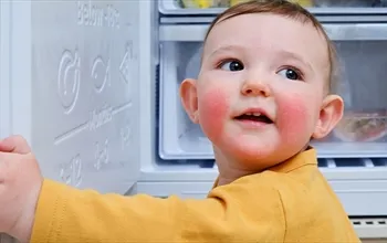 Çocuklarda besin alerjisi nasıl anlaşılır?