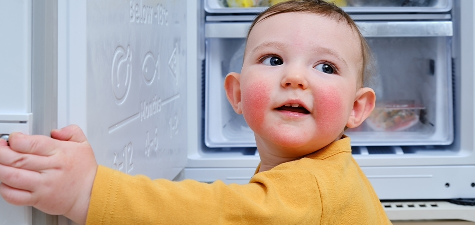 Çocuklarda besin alerjisi nasıl anlaşılır?