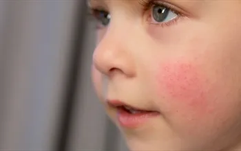 Çocuklarda cilt hastalıkları: Türleri, belirtileri ve tedavi yöntemleri
