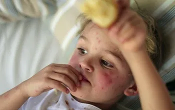 Çocukluk çağı lupus: Belirtileri, tanısı ve tedavisi