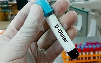 D-dimer testi: Pıhtılaşma ve tromboz değerlendirmesinde ne anlama gelir?