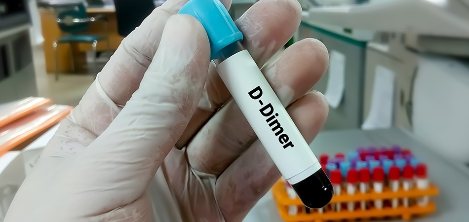 D-dimer testi: Pıhtılaşma ve tromboz değerlendirmesinde ne anlama gelir?