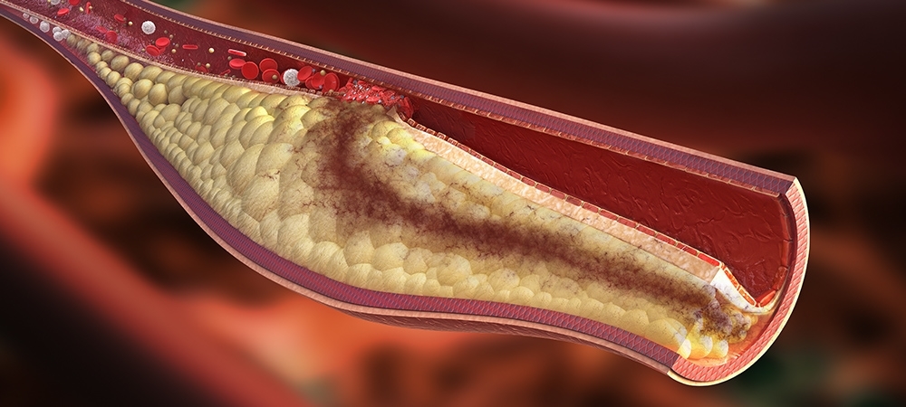 Damar tıkanıklığı neden olur? Damar tıkanıklığı nasıl açılır?