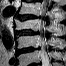 Kanal Darlığı (Spinal Stenoz)