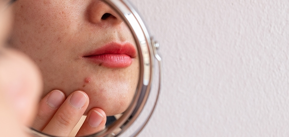 Deri iltihabı neden olur? Deri iltihabının belirtileri neler?