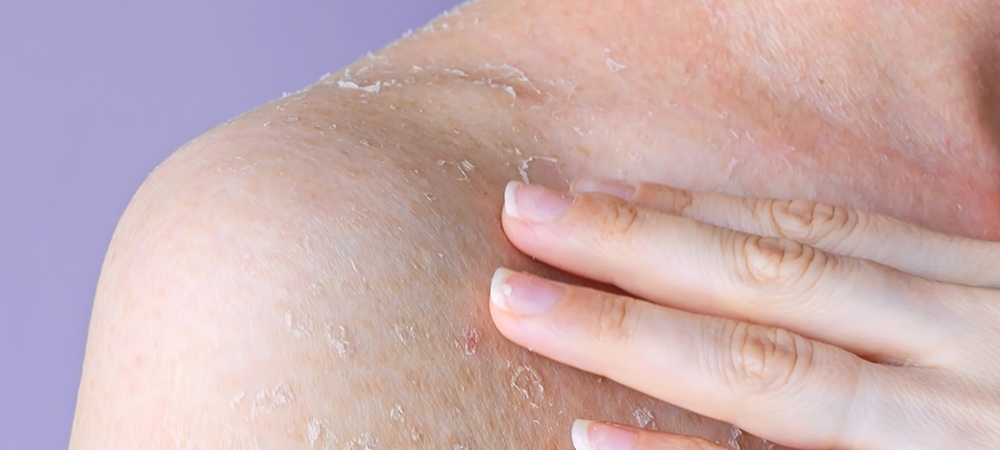 Deri soyulması neden olur? Deri soyulması ne iyi gelir?