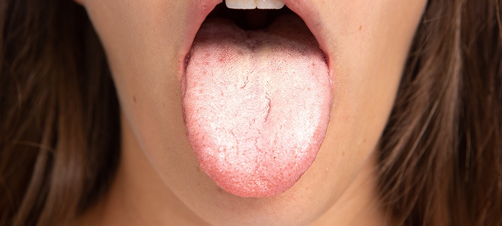 Dil mantarı (pamukçuk) nedir? Dilde mantar neden çıkar?