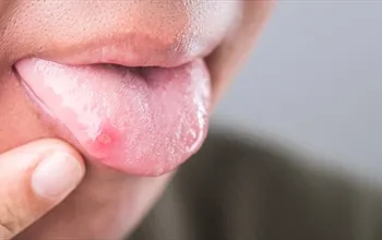 Dil yarası neden olur? Dil yarası neyin belirtisi olabilir?