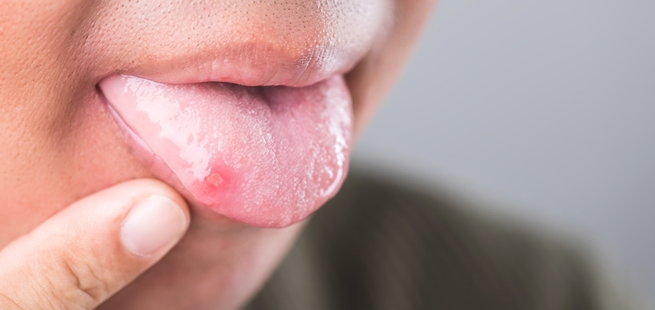 Dil yarası neden olur? Dil yarası neyin belirtisi olabilir?