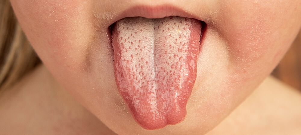 Dilde beyazlık neden olur? Dilin beyaz olması hangi hastalık belirtisi olabilir? 