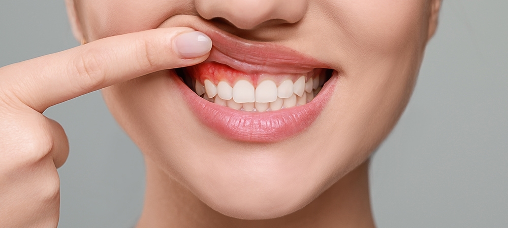 Diş apsesi neden olur? Dişte apse olduğu nasıl anlaşılır?