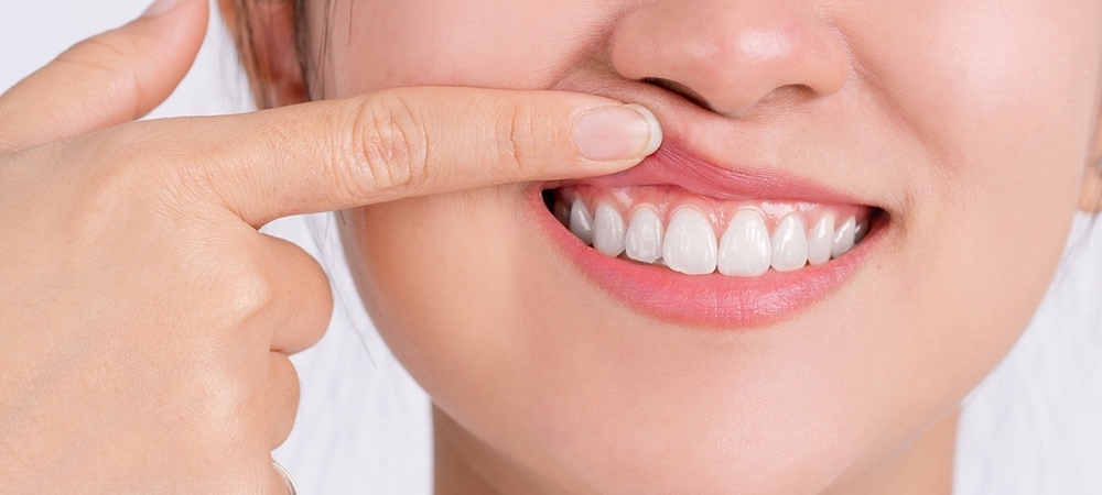 Diş eti çekilmesi neden olur? Diş eti çekilmesine ne iyi gelir?