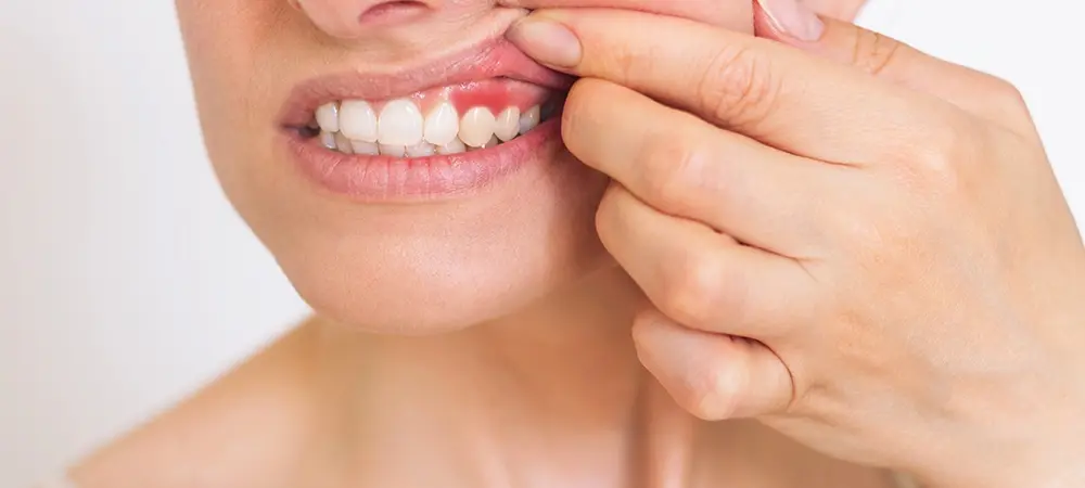 Diş eti şişmesi nedir? Diş eti şişmesi nasıl geçer? Diş eti şişmesi nedir? Diş eti şişmesi nasıl geçer?