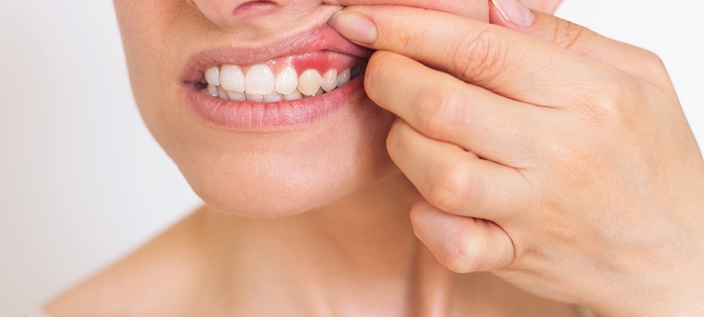 Diş eti şişmesi nedir? Diş eti şişmesi nasıl geçer?