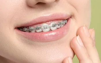 Diş teli nasıl takılır? Diş teli kaç yıl kalmalı?