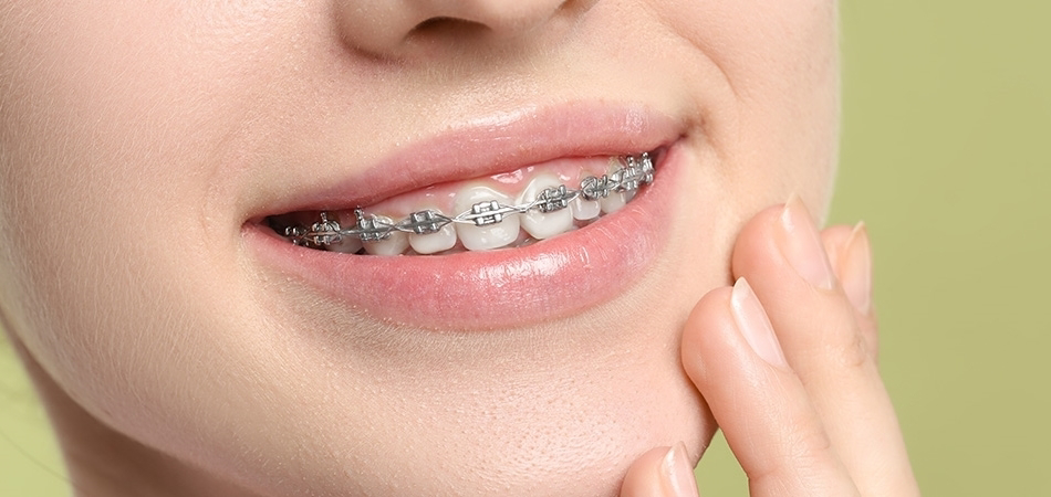 Diş teli nasıl takılır? Diş teli kaç yıl kalmalı?