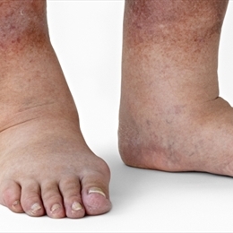 Diyabetik Nefropati Nedir?