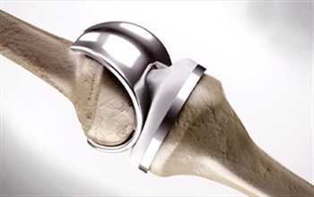 “Diz protezi hareket kısıtlılığı ve ağrıyı ortadan kaldırıyor”