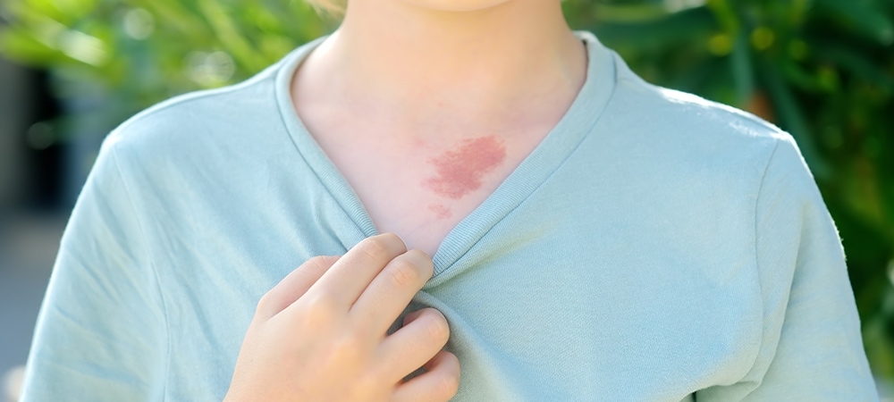 Doğum lekesi nedir? Doğum lekesi nasıl anlaşılır?