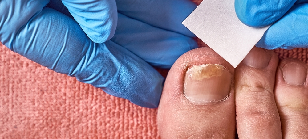 Dolama (tırnak enfeksiyonu) nedir? Dolama neden olur?