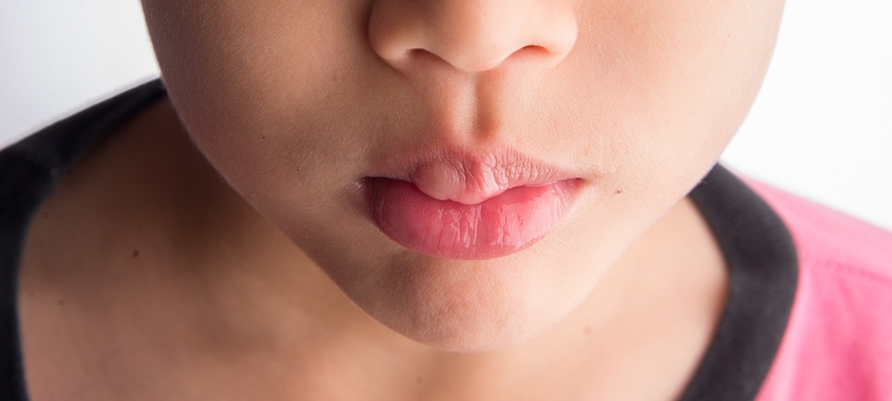 Dudak şişmesi neden olur? Dudak şişmesi nasıl geçer?