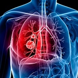 Pulmoner Emboli