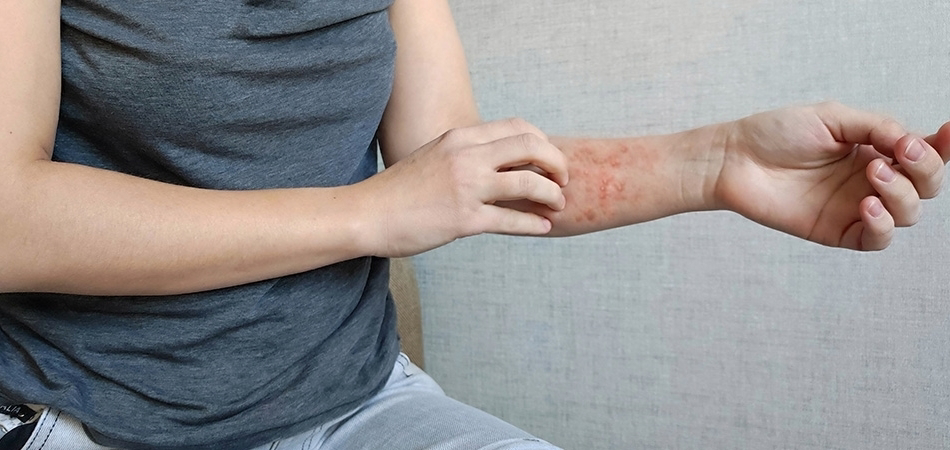 Egzamanın doğal ilacı nedir? Egzama için bitkisel tedavi yöntemleri nelerdir?