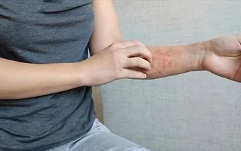 Egzamanın doğal ilacı nedir? Egzama için bitkisel tedavi yöntemleri nelerdir?