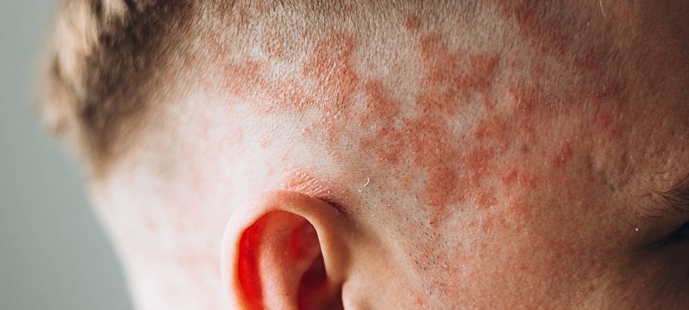 Egzama nedir? Egzamanın belirtileri nelerdir?