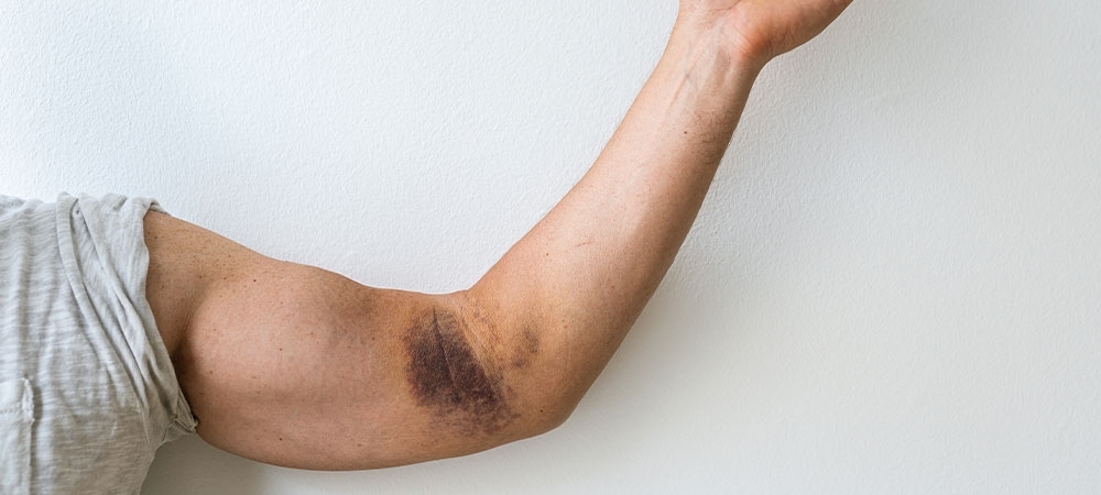 Ekimoz nedir? Ekimoz neden olur?