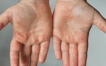 El ayak ağız hastalığı nasıl geçer? El ayak ağız hastalığı belirtileri nelerdir?