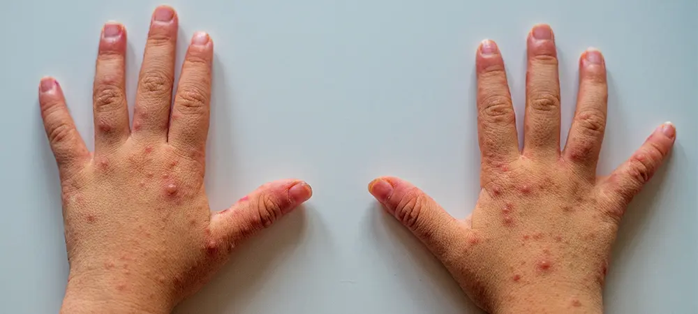El ayak ve ağız hastalığı nedir? El ayak ve ağız hastalığı belirtileri ve tedavisi El ayak ve ağız hastalığı nedir? El ayak ve ağız hastalığı belirtileri ve tedavisi