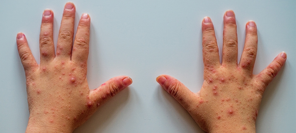 El ayak ve ağız hastalığı nedir? El ayak ve ağız hastalığı belirtileri ve tedavisi