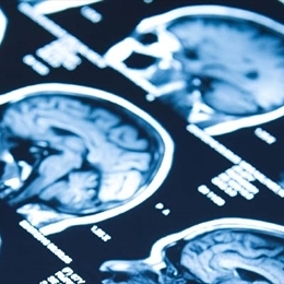 Epilepsi ve Epilepsi Cerrahisi Nedir?