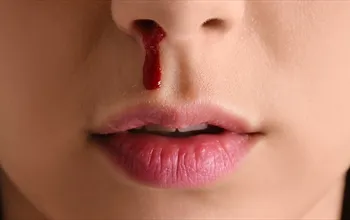 Epistaksis nedir? Epistaksis neden olur?