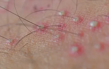 Folikülit nedir? Kıl kökü iltihabının nedenleri, belirtileri ve tedavisi