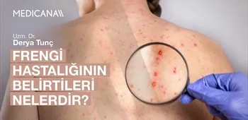 Frengi Hastalığının Belirtileri Nelerdir?