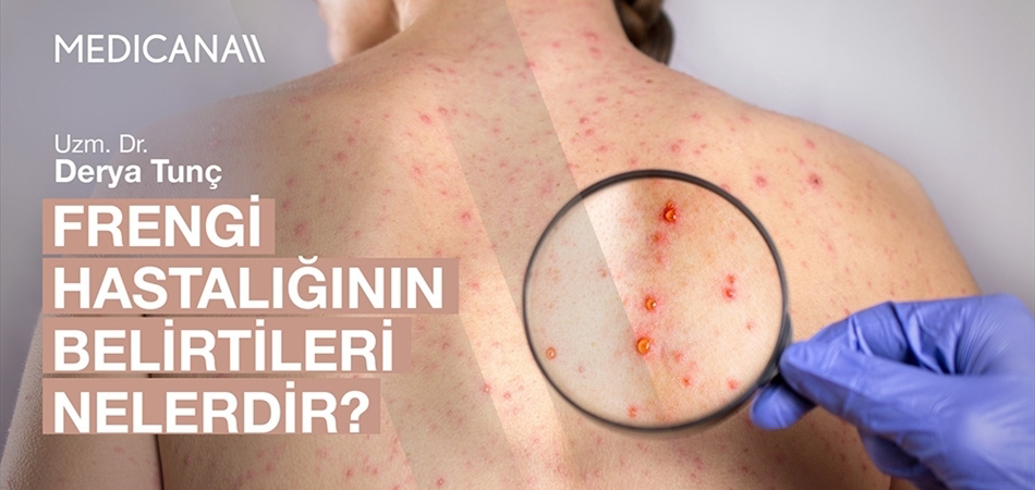 Frengi Hastalığının Belirtileri Nelerdir?