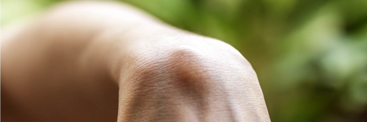 Gangliyon Kisti Nedir?