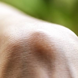 Gangliyon Kisti Nedir?