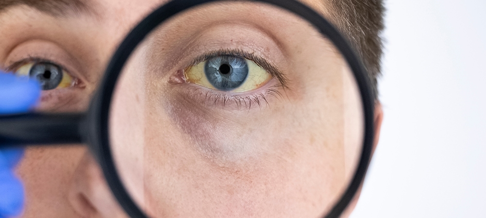 Gilbert sendromu nedir? Gilbert sendromu neye yol açar?