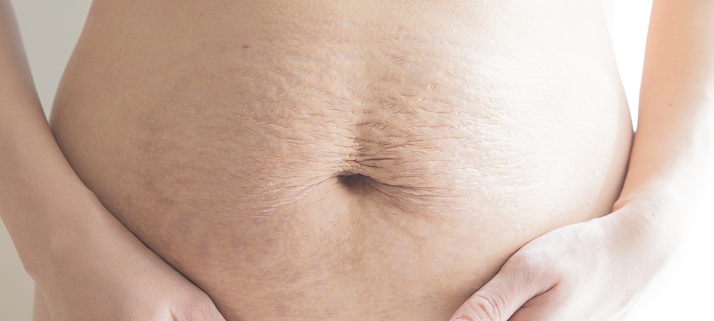 Göbek çatlakları neden olur? Göbekte oluşan çatlaklar nasıl geçer?