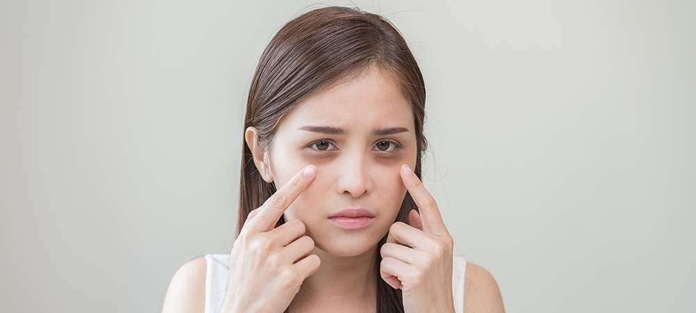 Göz altı morlukları neden olur? Göz altı morlukları nasıl geçer?