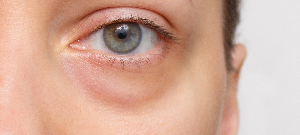 Göz altı torbaları neden olur? Evde göz altı torbaları nasıl giderilir?