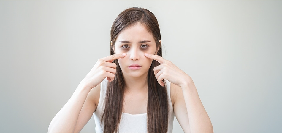 Göz altı morlukları nasıl geçer? Gözaltı morlukları için evde ne yapılabilir?