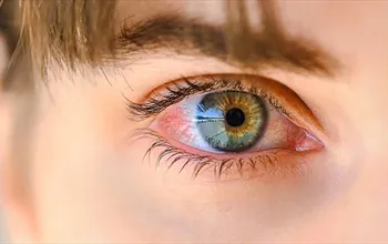 Göz iltihabı neden olur? Göz iltihabı neyin belirtisi olabilir?