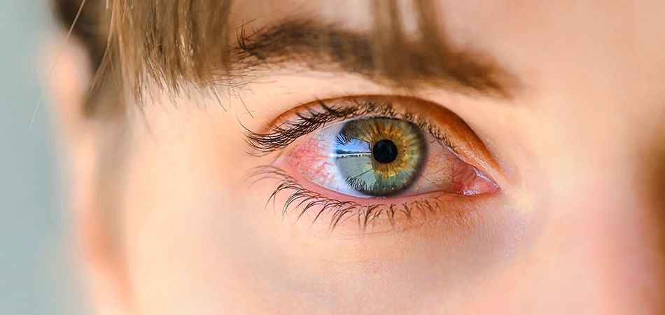 Göz iltihabı olduğu nasıl anlaşılır? Gözde iltihap varsa ne yapmalı?